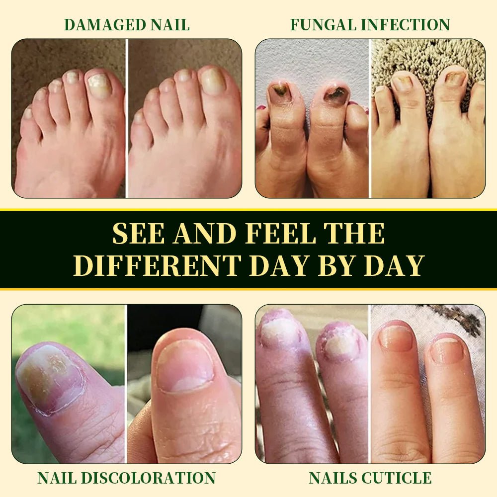 🦶 FINGERNAILS AND TOENAILS ALIKE